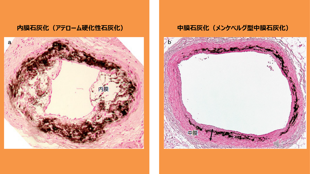 血液透析患者の長期にわたるリンコントロールと大血管の石灰化