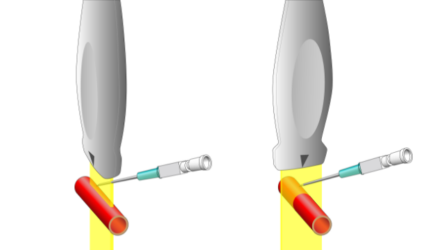 エコーガイド下穿刺の適応と症例